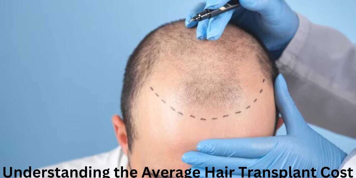 Understanding the Average Hair Transplant Cost